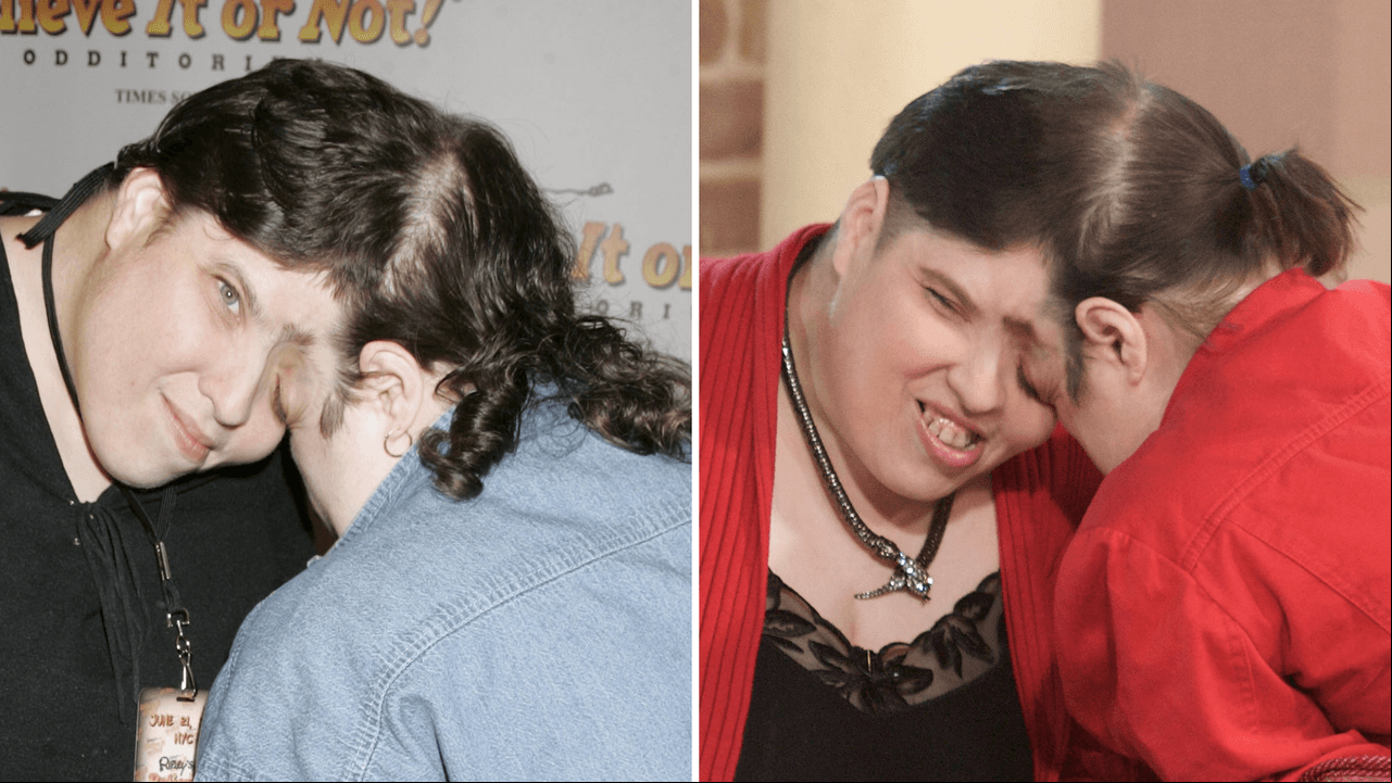 Así fue la vida de los siameses más longevos de la historia, Lori y George Schappell