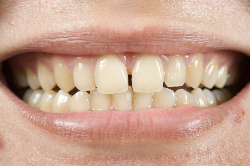 Antes de seguir ignorando el sangrado cuando te lavas los dientes, lee esto